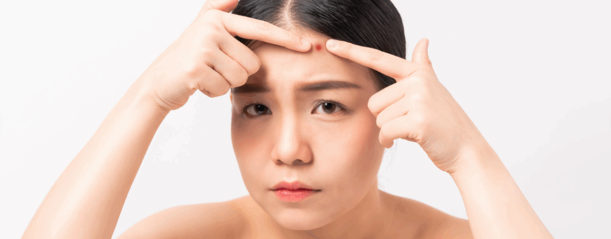 おでこのニキビはなぜできる？原因や治し方、改善する方法を詳しく解説
