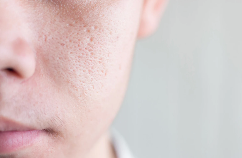 クレーター毛穴とは | 種類や特徴、できる原因や治療方法を解説